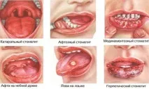 лікування