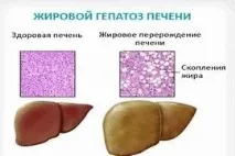 ГЕПАТОЗ ЖИРОВИЙ жировий