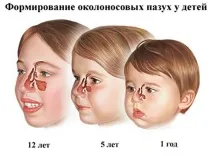 Гайморові пазухи (верхньощелепна пазуха) розташування, будова верхньощелепна