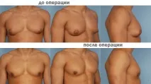 Гінекомастія симптоми, ознаки, діагностика та лікування гінекомастія