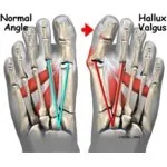 Hallux Valgus valgus