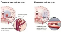 Інфаркт мозку - чим інфаркт відрізняється від інсульту, різниця, відмінності, що гірше, що страшніше, що різниця