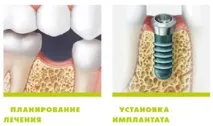 Straumann