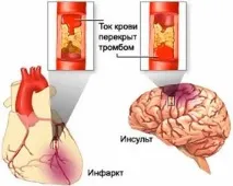 Інфаркт мозку - чим інфаркт відрізняється від інсульту, різниця, відмінності, що гірше, що страшніше, що інфаркт