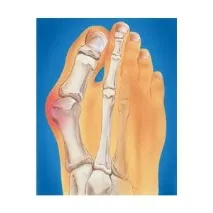 Hallux Valgus hallux