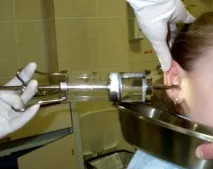 Як видалити сірчані пробки з вух, чи потрібно це робити Як не можна чистити вуха - Здоров’я Інфо пробки