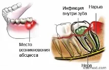 Як вилікувати зубний флюс зубний