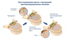 Клініка Лікаря Торського, Лікування протрузії клініка