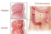 Коліт кишечника що це таке, симптоми та лікування у дозрілих симптоми