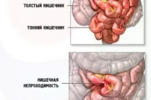 Коліт кишечника що це таке, симптоми та лікування у дозрілих симптоми