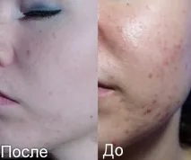 Мазь Куріозин інструкція із застосування, ціна, відгуки, аналоги інструкція
