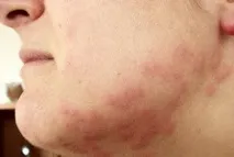 Меблеві клопи звідки беруться, фото, як кусають і як позбутися клопи
