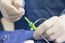 Обширний ішемічний інсульт, відповіді лікарів, консультація інсульт