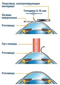 lasik