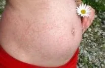 Оперезуючий лишай або оперізувальний герпес при вагітності оперізувальний