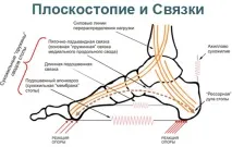 Плоскостопість Види Симптоми Профілактика симптоми