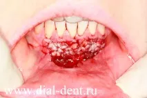 Пластика вуздечки нижньої губи нижньої