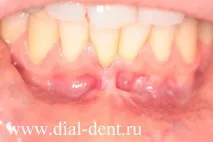 Пластика вуздечки нижньої губи нижньої