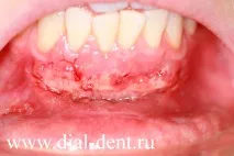 Пластика вуздечки нижньої губи нижньої