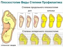 Плоскостопість Види Симптоми Профілактика симптоми
