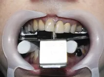 Застосування аналізатора HIP-площини в ортопедичній стоматології - Dental Magazine застосування