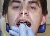 Застосування аналізатора HIP-площини в ортопедичній стоматології - Dental Magazine застосування