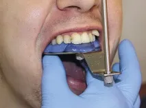 Застосування аналізатора HIP-площини в ортопедичній стоматології - Dental Magazine ортопедичній