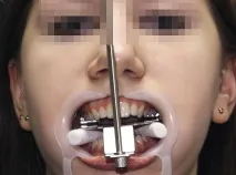 Застосування аналізатора HIP-площини в ортопедичній стоматології - Dental Magazine hip-площини