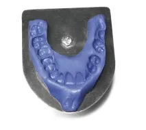 Застосування аналізатора HIP-площини в ортопедичній стоматології - Dental Magazine аналізатора