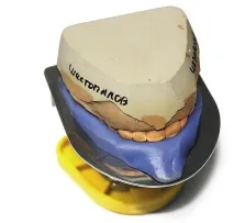 Застосування аналізатора HIP-площини в ортопедичній стоматології - Dental Magazine hip-площини