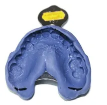 Застосування аналізатора HIP-площини в ортопедичній стоматології - Dental Magazine застосування