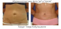 Пупок після абдомінопластики, пупкові грижі абдомінопластики