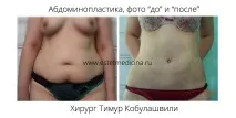 Пупок після абдомінопластики, пупкові грижі після