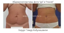 Пупок після абдомінопластики, пупкові грижі пупкові