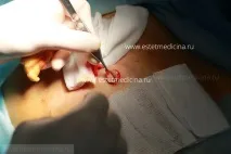 Пупок після абдомінопластики, пупкові грижі після