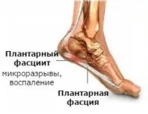 П’яткова шпора - Медичний центр - Здоров’я плюс центр