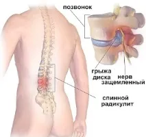 Радикуліт поперекової області - причини, симптоми, лікування області