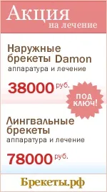 Розстрочка на брекети та ортодонтію розстрочка