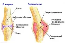 Ревматизм суглобів симптом та лікування, масаж при ревматизмі лікування