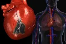 Ревматизм суглобів симптом та лікування, масаж при ревматизмі ревматизм