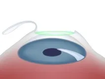 Супер ЛАСІК (Super LASIK) зору