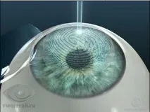 Супер ЛАСІК (Super LASIK) ласік
