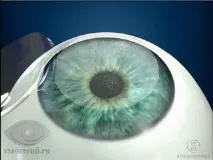 Супер ЛАСІК (Super LASIK) Супер