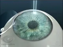 Супер ЛАСІК (Super LASIK) зору