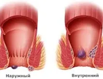 Трава коров’як від геморою лікування, відгуки відгуки