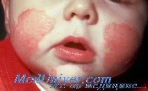 Природжені порушення метаболізму у дітей клініка, діагностика порушення