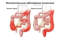Жовчогінні препарати при панкреатиті властивості та правила вибору жовчогінні