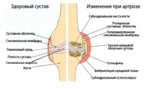 Артроз пальців ніг - класифікація, причини, симптоми, діагностика та методи лікування пальців