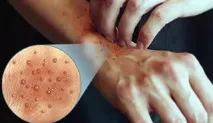 симптоми