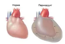 Біль у грудині зліва віддає в лопатку та руку, причини біль